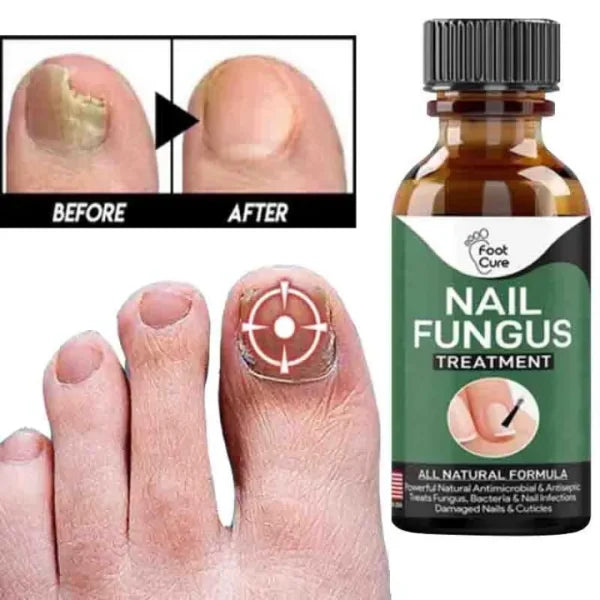 Fast Nail Fungal Treatments Nail Repair Essences Serum Care Treatments Foot Nail Fungus Removal Gel, Up to 50,000 trusted peoples