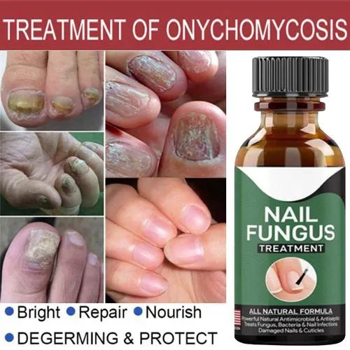 Fast Nail Fungal Treatments Nail Repair Essences Serum Care Treatments Foot Nail Fungus Removal Gel,   Up to 50,000 trusted peoples